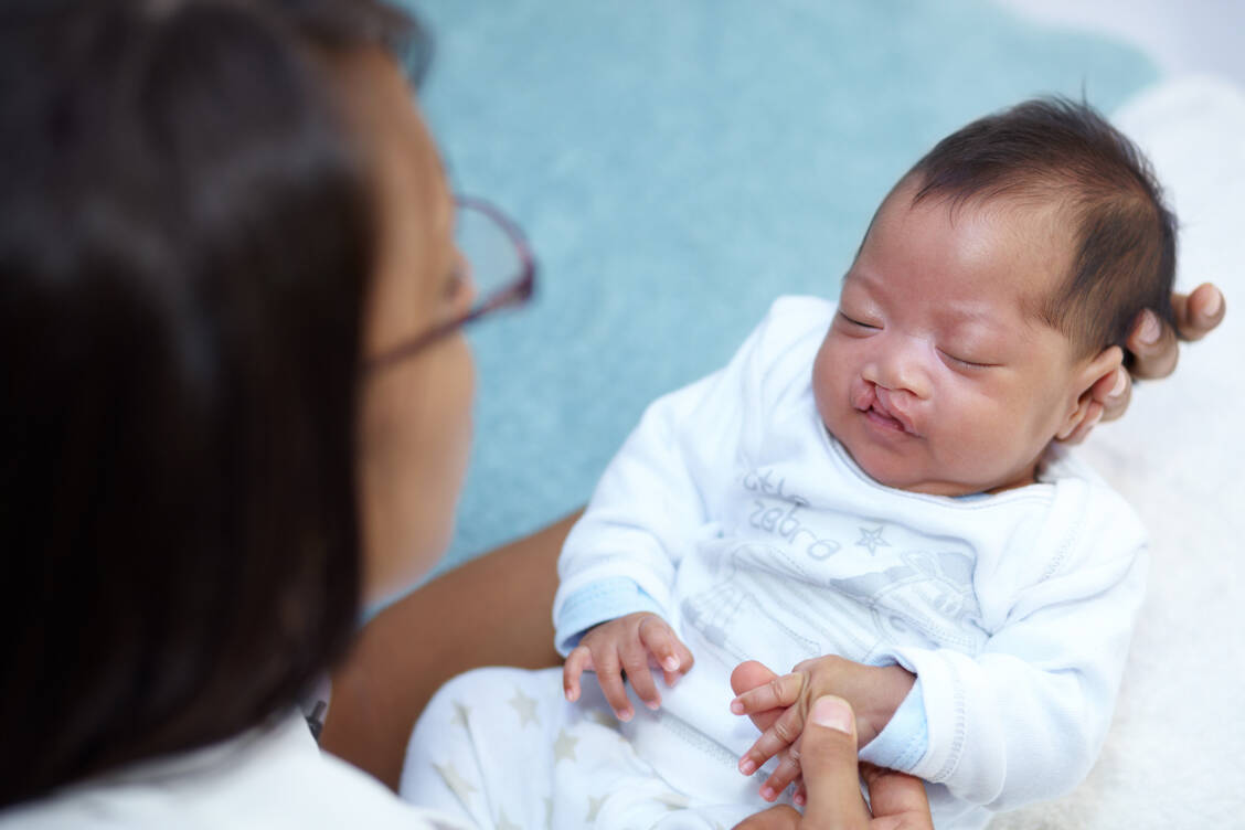 Die Lippen-Kiefer-Gaumenspalte ist eine der häufigsten angeborenen Fehlbildungen, rund eines von 600 Babys in Deutschland ist betroffen. / © Adobe Stock/Thomas Talkner/peopleimages.com
