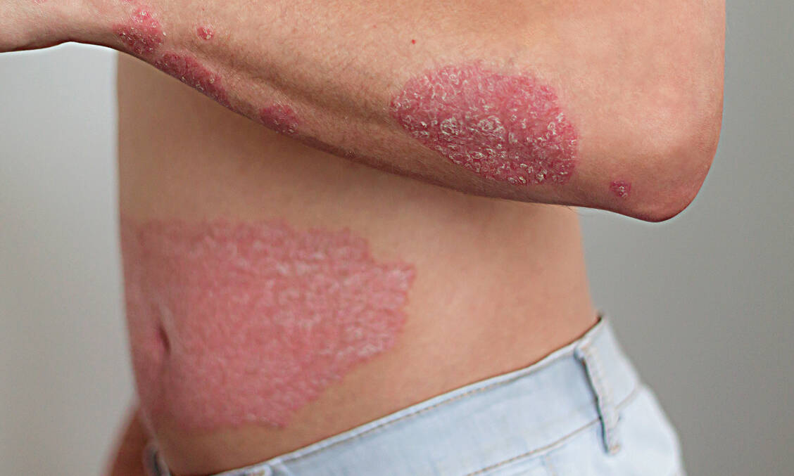 Mit entzündlichen juckenden Hautauschlägen, sogenannte Plaques, haben Psoriasis-Patienten zu kämpfen. Doch die Krankheit betrifft auch die Gefäße, wie man heute weiß. / Foto: Getty Images/Irina Gulyayeva