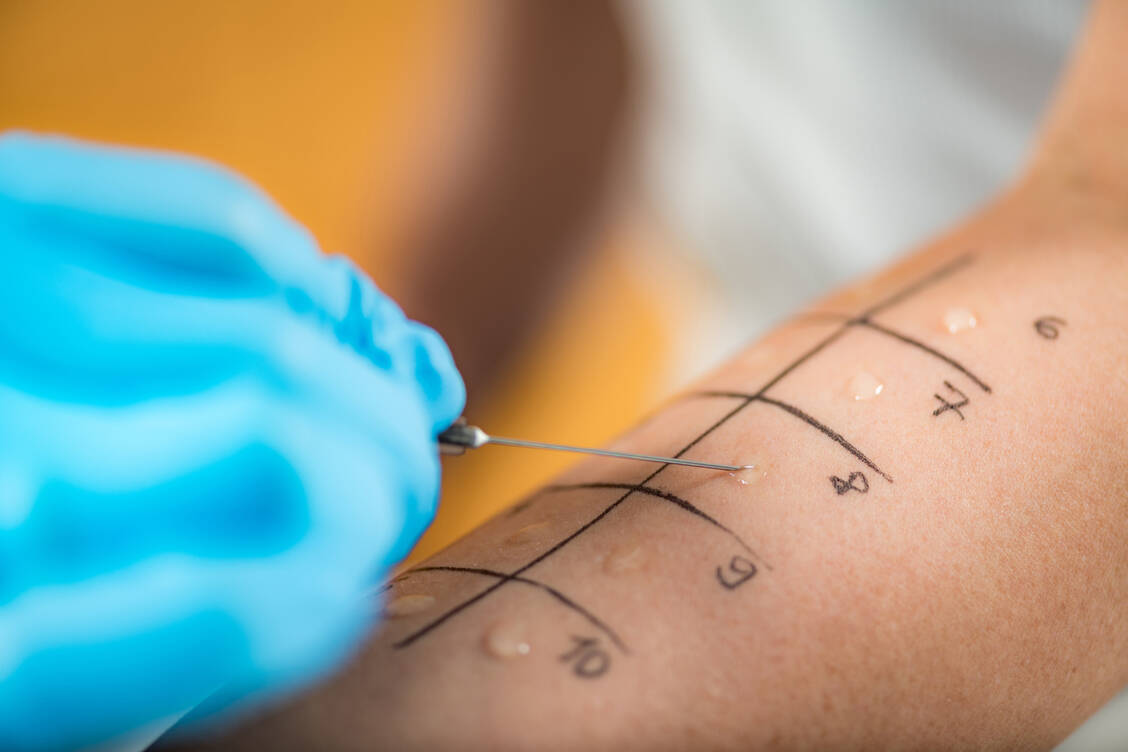 Der Pricktest kann Hinweise auf mögliche Ursachen einer Dermatose geben. / Foto: Adobe Stock/Microgen
