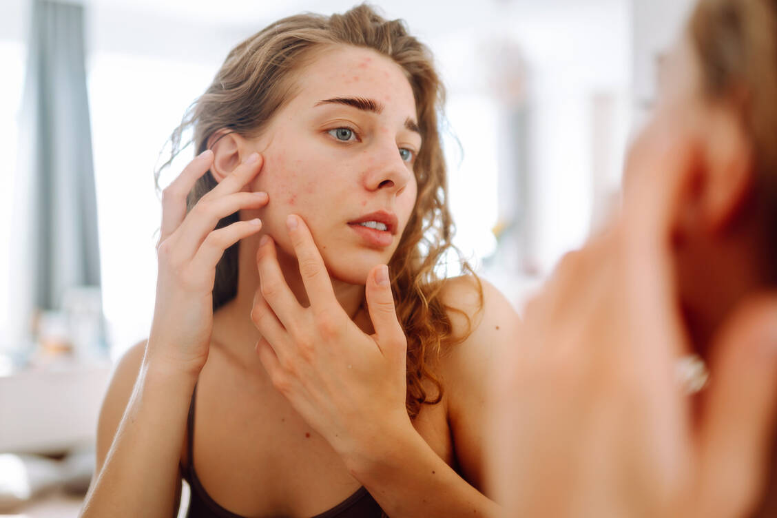 Ein Auslöser für Skin Picking kann der Blick in Spiegel oder ein neuer Pickel sein. / Foto: Getty Images/Maksym Belchenko