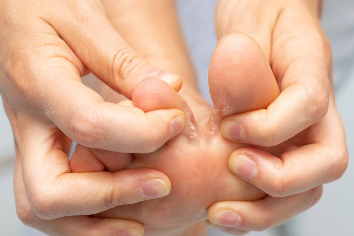 Juckreiz, Schuppen und aufgequollene weißliche Haut: Die Tinea pedis macht sich meistens zwischen den Zehen bemerkbar. / © Getty Images/Wirestock