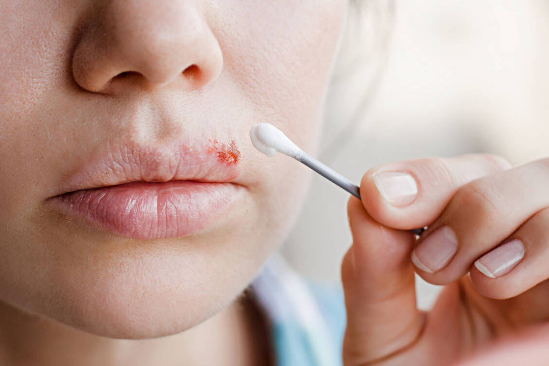 Cremes mit Aciclovir und Penciclovir schneiden bei Stiftung Warentest nicht gut ab. / Foto: Shutterstock/Domaskina