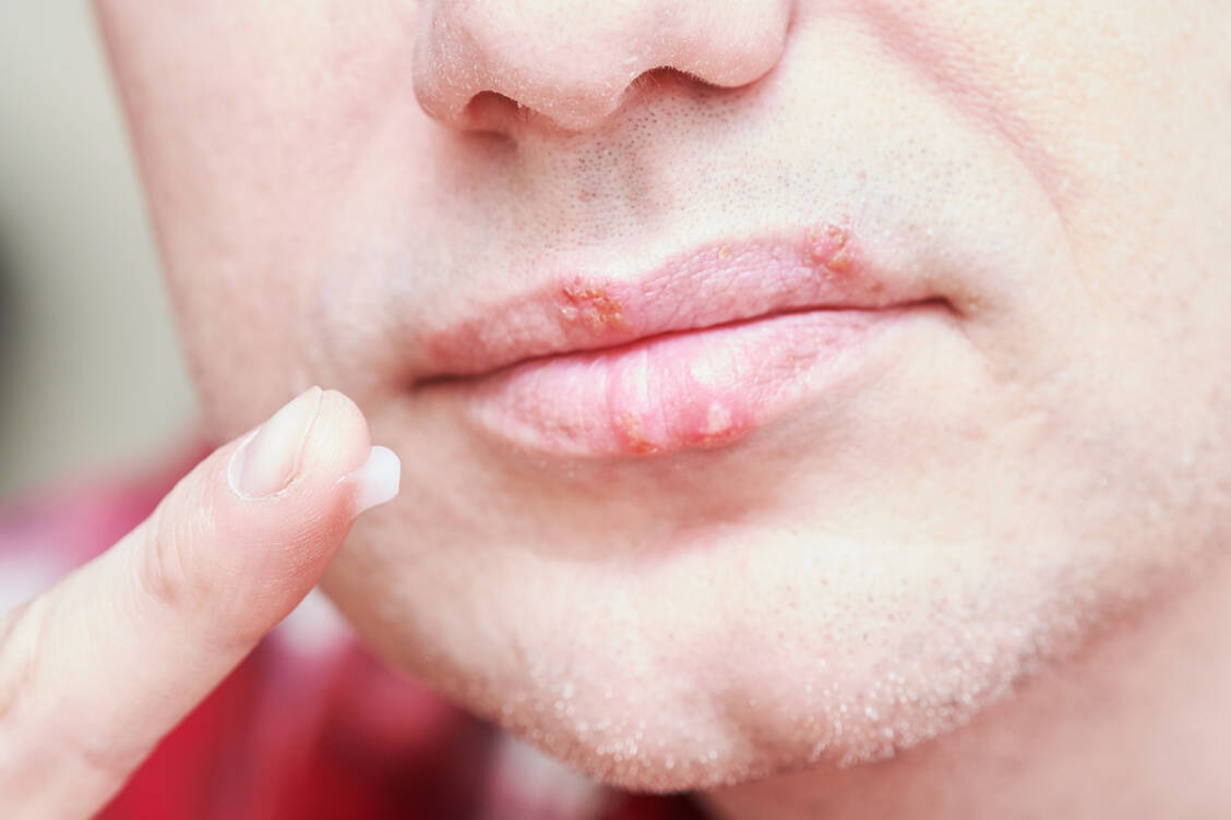 Herpesbläschen sind unangenehm. Der frühe Einsatz von (pflanzlichen) Medikamenten verspricht Hilfe. / Foto: Adobe Stock/Kadmy