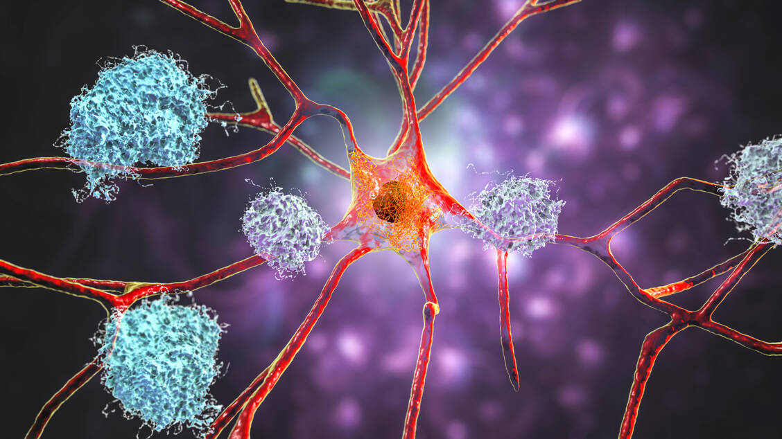 Die Alzheimer-Krankheit ist durch das Absterben von Nervenzellen im Gehirn gekennzeichnet. Proteinablagerungen wie Amyloid-Plaques könnten dafür verantwortlich sein. / Foto: Getty Images/KATERYNA KON/SCIENCE PHOTO LIBRARY