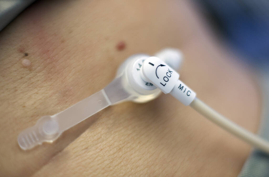 Muss die enterale Ernährung voraussichtlich länger erfolgen, wird eine perkutane Sonde gelegt. / Foto: Science Photo Library