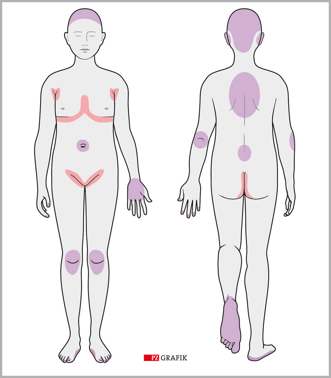 Typische betroffene Hautstellen bei Psoriasis vulgaris (lila) und Psoriasis inversa (rosa). Während bei Psoriasis vulgaris die Plaques am gesamten Körper auftreten können und silbrige Schuppen aufweisen, zeigt sich die Psoriasis inversa in Hautfalten oft ohne Schuppen. / © Stephan Spitzer