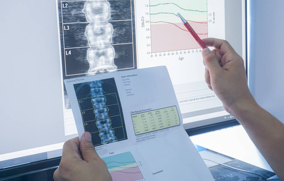Osteoporose bleibt oft unentdeckt. Experten raten daher dringend zur Knochendichtemessung.  / © Getty Images/Tonpor Kasa