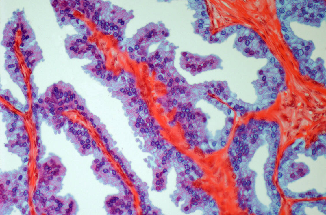 Prostatskrebszellen in einer mikroskopischen Aufnahme / Foto: Bayer Vital
