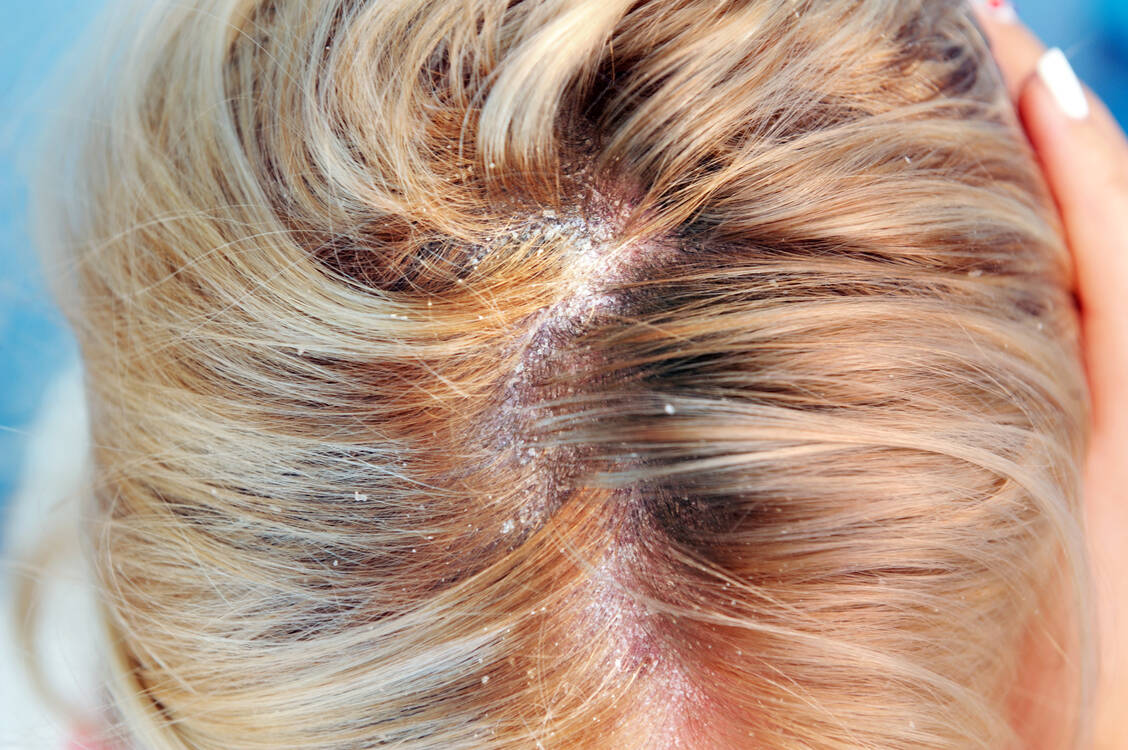 Auch die Kopfhaut können Pilze befallen, das ist eine juckende Angelegenheit.  / Foto: Adobe Stock/lial88