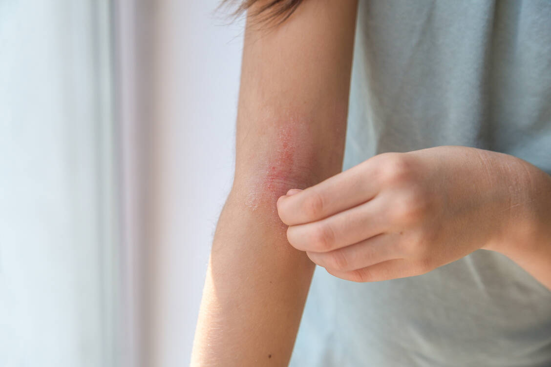 Rötungen, Trockenheit und oft quälender Juckreiz: Mit der richtigen Therapie und Pflege kann die Haut wieder ins Gleichgewicht kommen. / © Getty Images/Evgeniia Gordeeva
