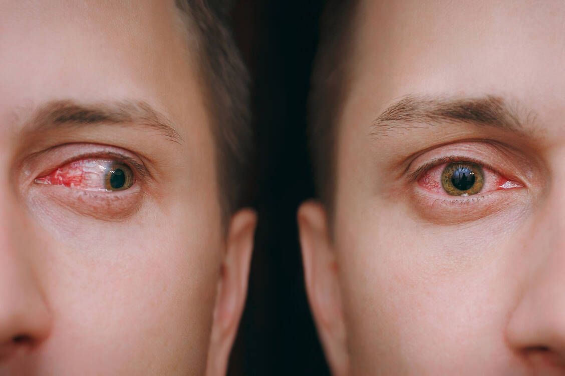 Bei anhaltend geröteten Augen heißt es: Ab zum Augenarzt! Denn es könnte eine Erkrankung dahinterstecken, die die Sehkraft beeinträchtigen könnte.  / Foto: Getty Images/ViDi Studio