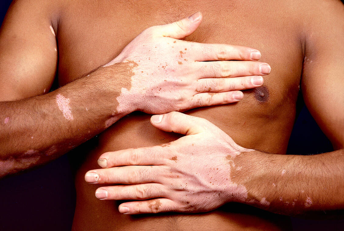 Das seelische Leid von Menschen mit Vitiligo ist oft sehr groß.  / Foto: © Neufried/OKAPIA