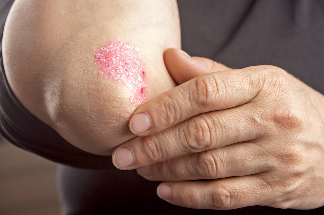 Der neue Antikörper Risankizumab wird bei Schuppenflechte eingesetzt. / Foto: Shutterstock/Hriana