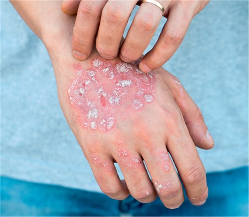 Kratzen oder sonstige  Manipulation an den betroffenen Hautstellen, verschlechtert  die Symptomatik.
<p class="fotonachweis">Foto: Shutterstock/2Ban</p>