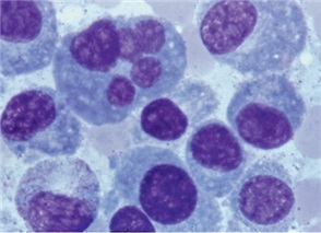 Detailaufnahme: Plasmazellen beim Multiplen Myelom.
<p class="fotonachweis">Foto: Universitätsklinikum Heidelberg</p>