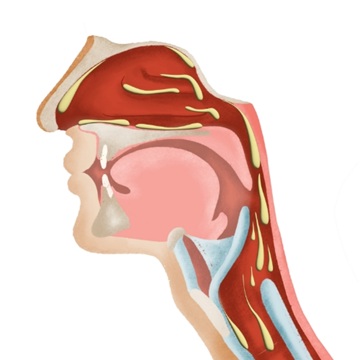 Copyright: G. Pohl-Boskamp GmbH & Co. KG
Abb. 1: Beim Postnasal-Drip fließt infizierter Schleim über den Rachen in Richtung der Bronchien. Neben einer Nasennebenhöhlenentzündung kann es dann auch zu einer Bronchitis kommen.
