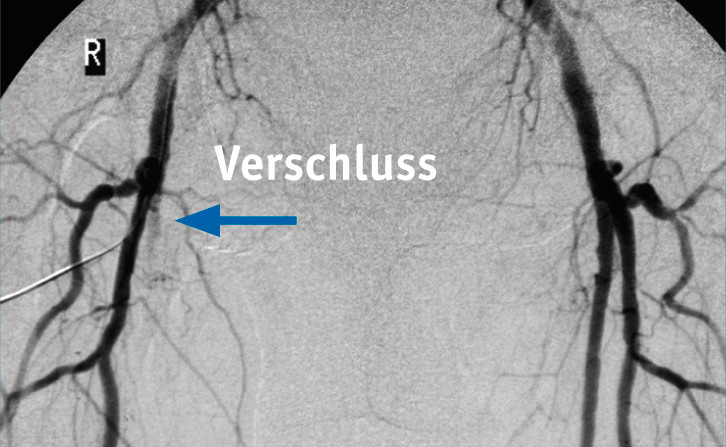 Ein Angiogramm zeigt Verschluss. / Foto: Deutsche Gesellschaft für Angiologie