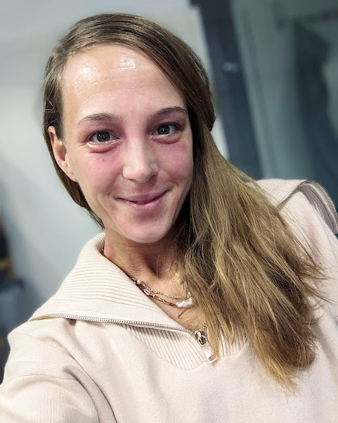 Teresa Walter berichtet auf ihrer Instagramseite »theatritralisch« und dem gleichnamigen Blog unter anderem über ihre Hauterkrankung.  / Foto: privat